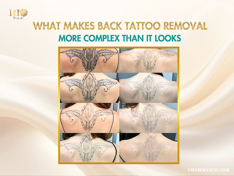 Process of professional back tattoo removal showing fading results over multiple laser sessions.