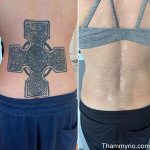 Before and after result of professional back tattoo removal for a large Celtic cross design.