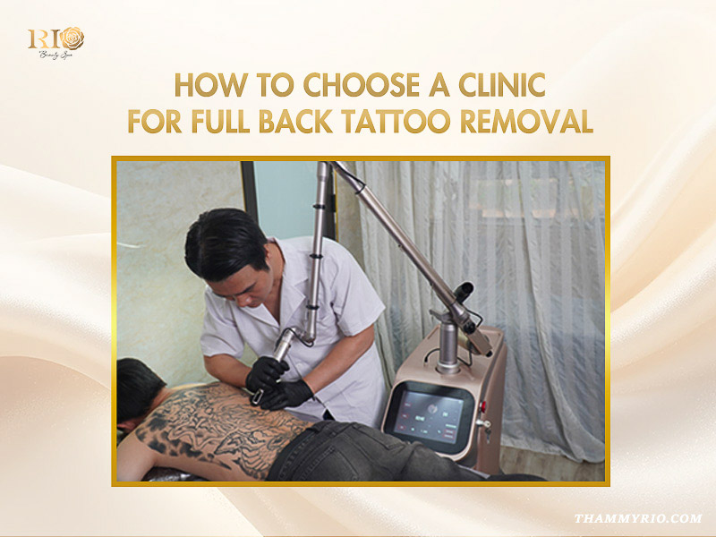 Expert performing safe and effective full back tattoo removal using advanced laser technology.