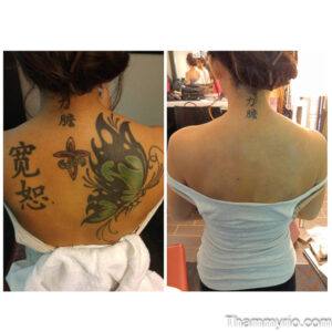 Before and after result of back tattoo removal showing complete removal of large tattoos.