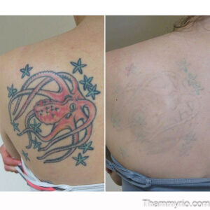 Before and after comparison of colorful back tattoo removal using professional laser technology.