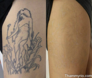 Before and after comparison of a big tattoo removal process on a large thigh tattoo featuring a woman and flowers.