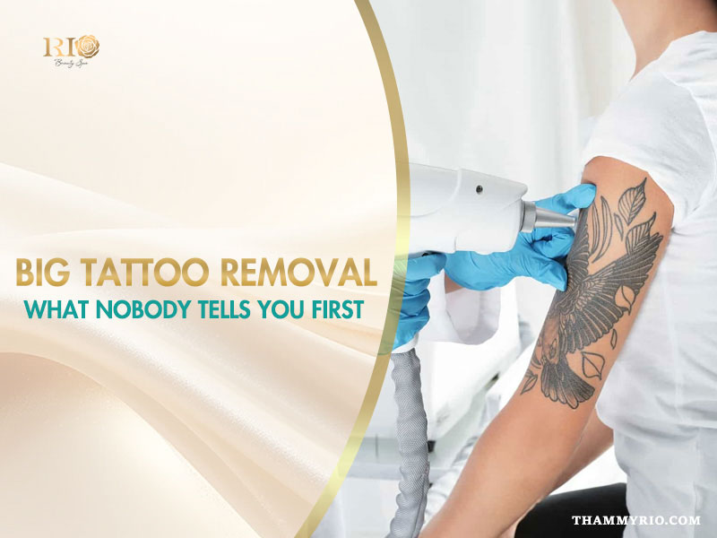 Professional performing a big tattoo removal procedure on a large bird tattoo on a woman's upper arm using laser technology.