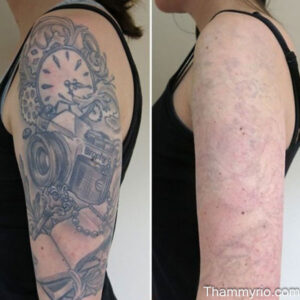 A split image of before and after big tattoo removal. The left side shows a large camera tattoo with "Brophy" text, and the right side shows the skin almost entirely clear.