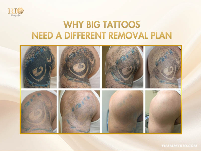 Photo collage showing the progress of big tattoo removal on a large tribal bắp tay tattoo. Text says: why big tattoos need a different removal plan.