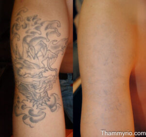 Before and after big tattoo removal results on a large black and grey dragon tattoo on the upper arm.