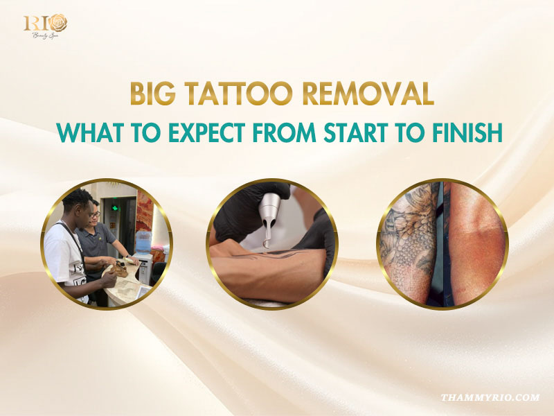 Infographic of the big tattoo removal process at Rio Beauty Spa showing consultation, laser treatment, and before-after results.