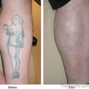 Before and after big tattoo removal results of a large female figure tattoo on a man's calf.