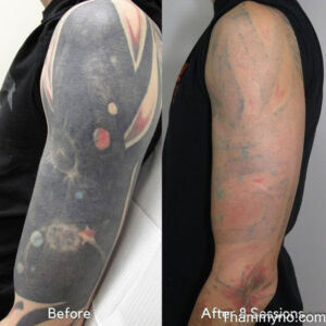 Before and after 8 sessions of blackout tattoo removal on a full arm sleeve featuring galaxy and planet motifs.