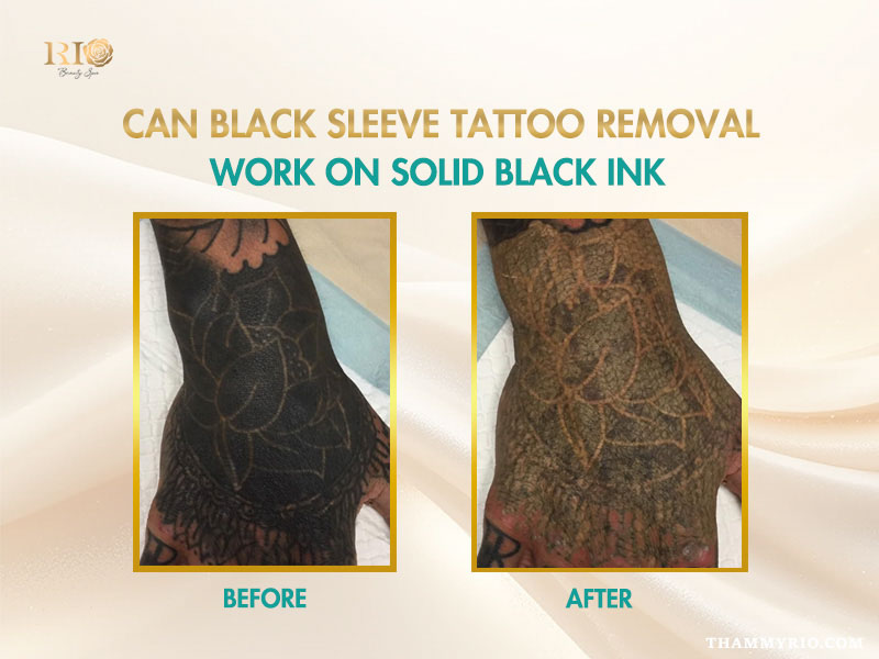Before and after comparison of blackout tattoo removal on a hand featuring a solid black ink floral design.