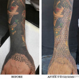 Before and after comparison of blackout tattoo removal on a forearm and hand using laser technology.