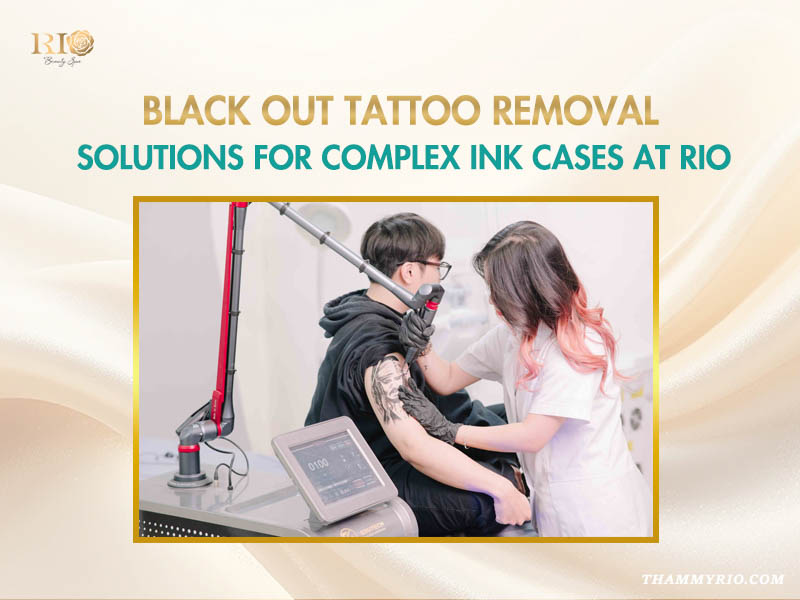 Professional blackout tattoo removal session at Rio beauty spa using advanced laser technology.