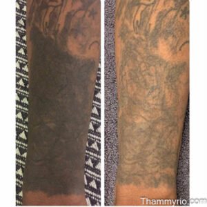 Side by side comparison showing significant ink fading after blackout tattoo removal sessions on a forearm.