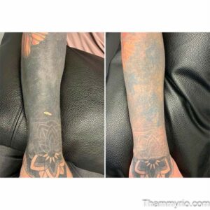 Blackout tattoo removal for dense black sleeves - Thẩm Mỹ Rio Beauty Clinic