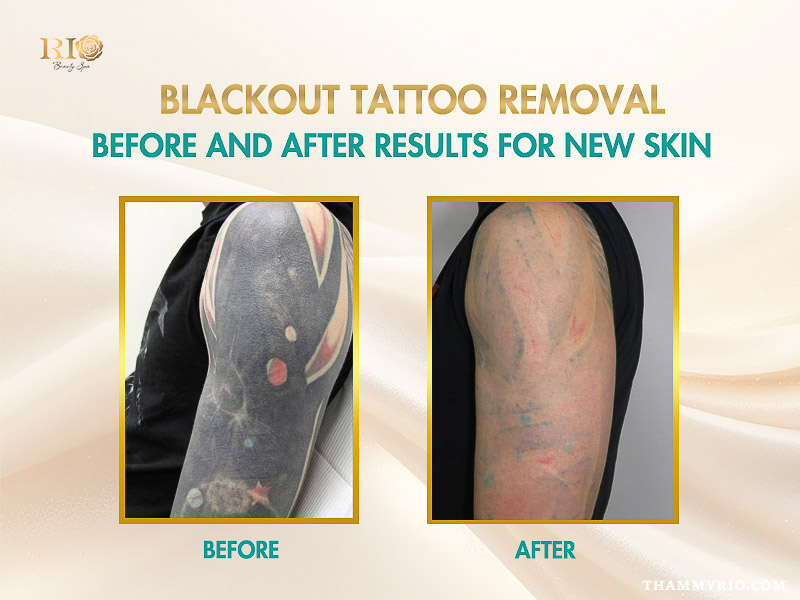 Blackout tattoo removal before and after results for new skin by Rio Beauty Spa