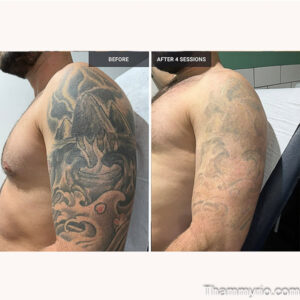 Blackout tattoo removal before and after 4 sessions on man's arm