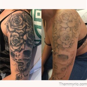 Blackout tattoo removal before and after on upper arm