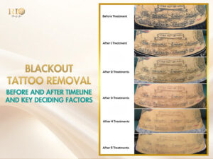 Blackout tattoo removal before and after timeline from Rio Beauty Spa