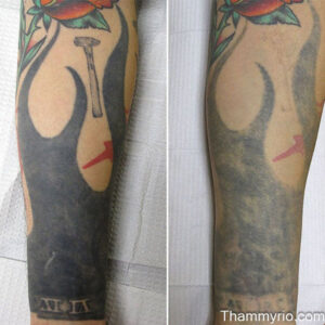 Blackout tattoo removal before and after on a heavy black ink forearm