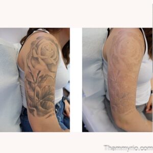 Blackout tattoo removal before and after showing a faded rose on arm