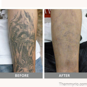 Blackout tattoo removal before and after showing complete clearing on arm