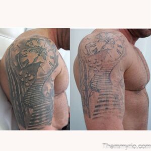 Man's arm showing large blackout tattoo removal before and after results