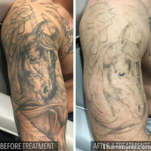 Blackout tattoo removal before and after 4 treatments on man's bicep