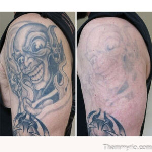 Blackout tattoo removal before and after on a man's bicep