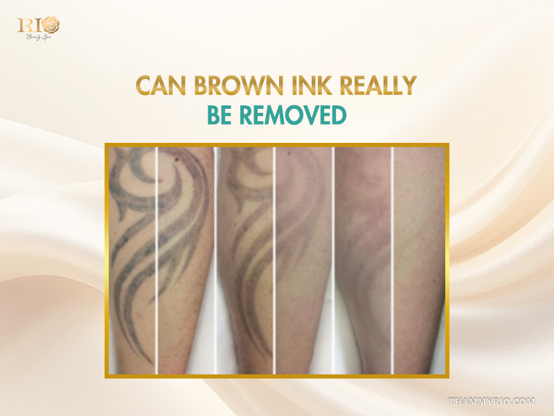 Before and after stages of brown tattoo removal on an arm showing successful ink fading over multiple sessions.