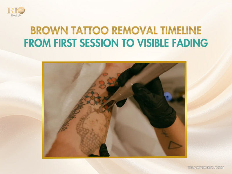Laser treatment process for brown tattoo removal on a forearm with floral and patterned designs.