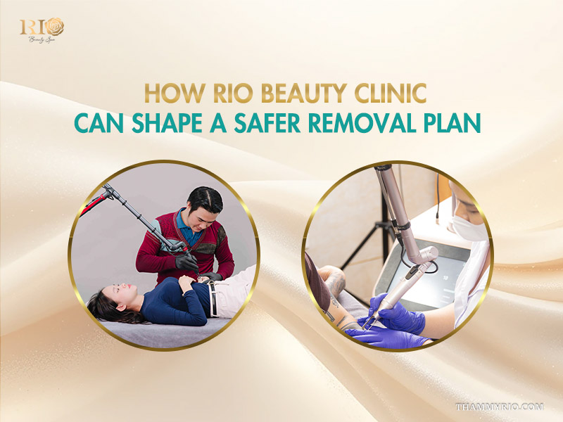 Professional advanced laser treatment for brown tattoo removal performed by certified experts at Rio Beauty Clinic.