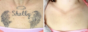 Before and after comparison of chest tattoo removal for a name and wings design.
