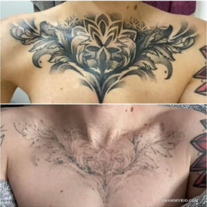 Before and after comparison of large mandala chest tattoo removal.