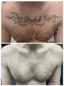 Before and after chest tattoo removal of cursive text design on upper chest.