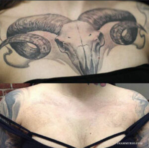 Before and after comparison of a large ram skull chest tattoo removal.