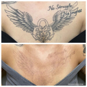 Before and after chest tattoo removal of a heart lock with wings and quote.