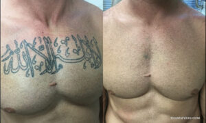 Before and after chest tattoo removal of Arabic calligraphy on a male chest.