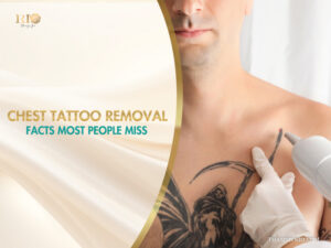 Laser chest tattoo removal of a Grim Reaper design at Rio Beauty Spa.