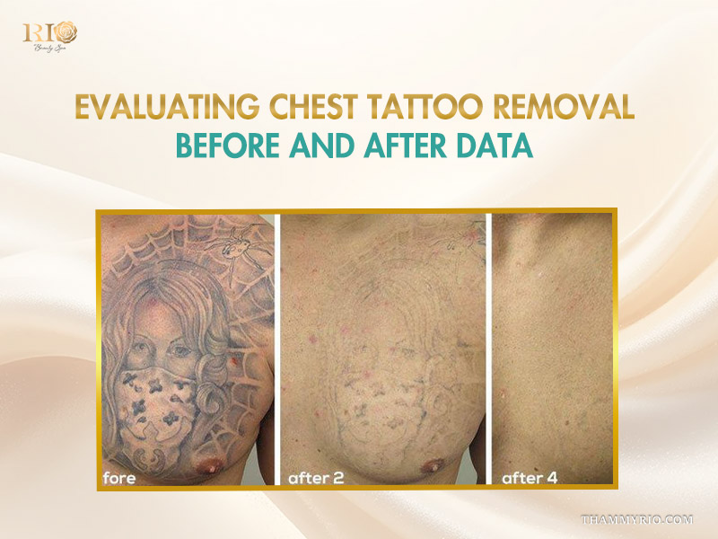 Evaluation of chest tattoo removal progress through 4 sessions at Rio Beauty Spa.