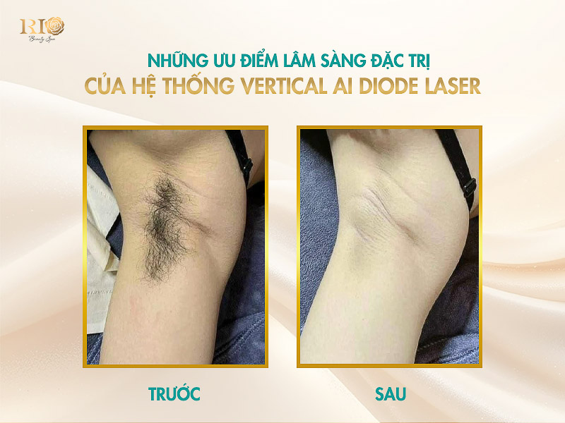 Kết quả triệt lông nách sạch hoàn toàn cho cơ địa lông cứng, rậm với công nghệ Vertical AI Diode Laser.