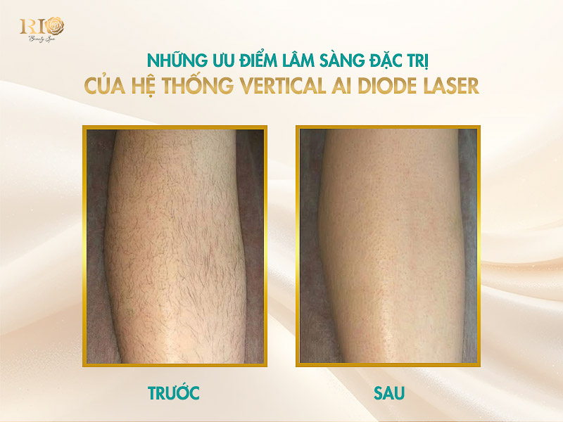 Triệt lông chân cứng, rậm sạch hoàn toàn, an toàn không đau rát với công nghệ Vertical AI Diode Laser.