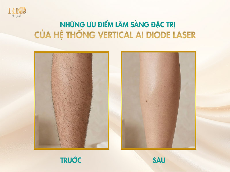 Triệt lông chân dày, rậm siêu sạch nhờ quét tầng sâu thông minh của công nghệ Vertical AI Diode Laser.