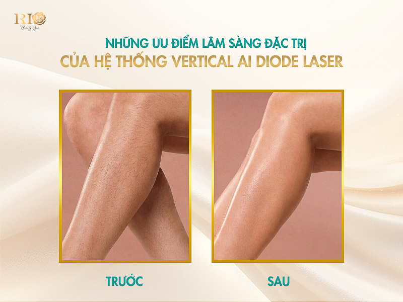 Kết quả triệt lông chân dày, rậm siêu sạch nhờ công nghệ Vertical AI Diode Laser với làm lạnh sâu âm 25 độ C.