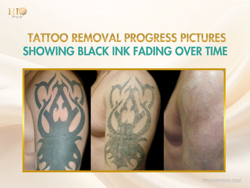 Dark tattoo removal before and after progress on a shoulder tattoo with black ink
