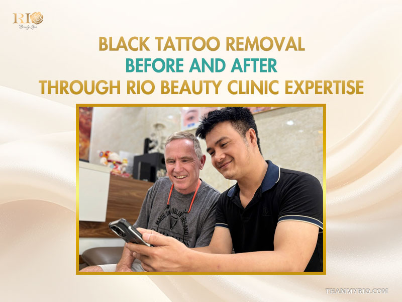 Professional dark tattoo removal before and after results at Rio Beauty Clinic