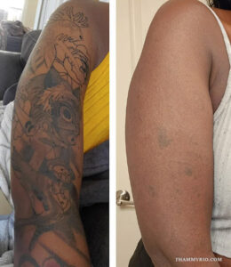 Dark tattoo removal before and after showing faded cartoon sleeve