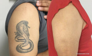 Dark tattoo removal before and after of a cobra design on arm