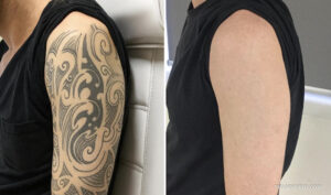 Dark tattoo removal before and after showing tribal ink clearance
