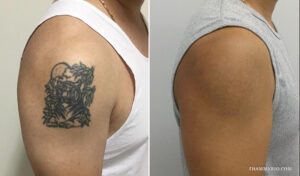 Dark tattoo removal before and after result on upper arm