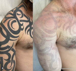 dark tattoo removal before and after showing faded tribal ink on shoulder and chest.